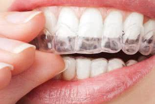 Wybielanie zębów. Czy jest szkodliwe?