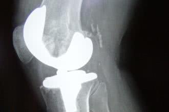 Endoproteza kolana - czy zawsze jest konieczna?