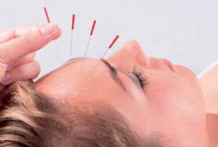 Akupunktura: terapia przyszłości stosowana od wieków