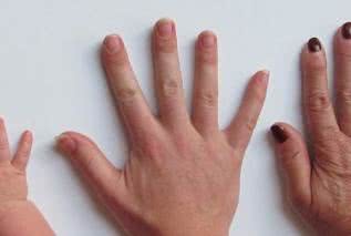 14 chorób, które można rozpoznać po objawach na dłoniach