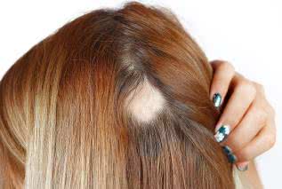 Łysienie plackowate - przyczyny, objawy, diagnostyka i leczenie alopecji 