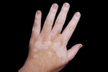 9 sposobów na bielactwo