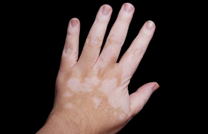 Bielactwo. Profilaktyka i leczenie