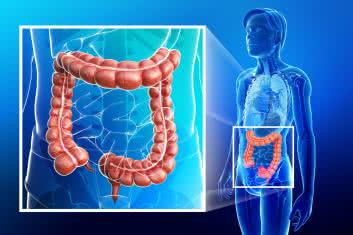 Wrzodziejącym zapaleniem jelita grubego