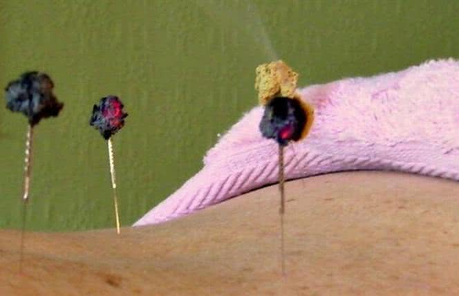 Akupunktura - na zmęczenie i depresję