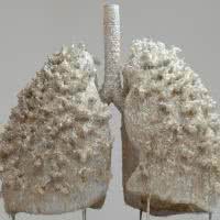 Spirometria - sposób na wykrycie chorób płuc