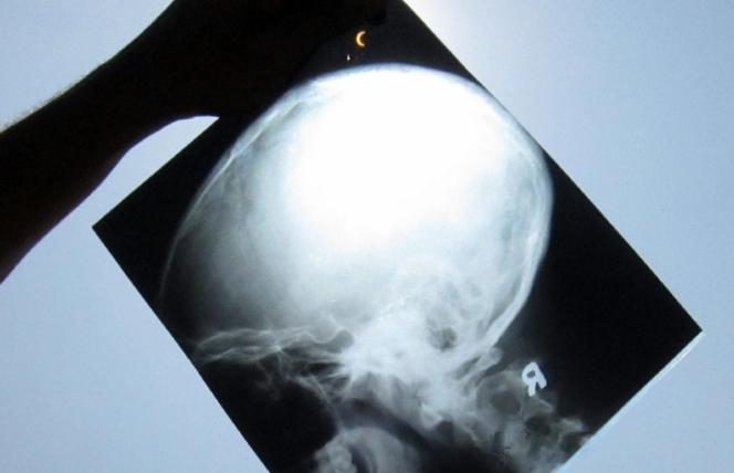 Biotyną w stwardnienie rozsiane