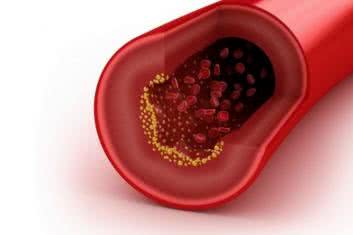 Same blaszki nie wystarczą, by wywołać chorobę Alzheimera