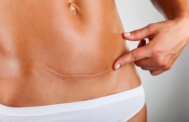 Jak sprawić, żeby blizny znikły?