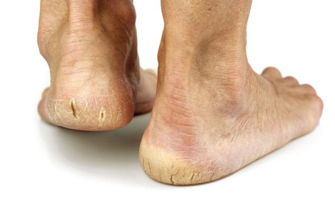 Stopy - jak o nie dbać?