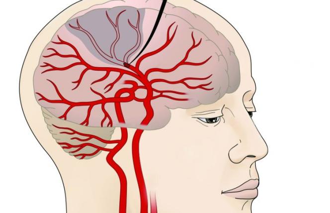 Zbyt długi sen zwiększa ryzyko udaru