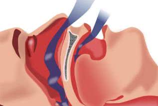 Bezdech senny groźniejszy dla kobiet