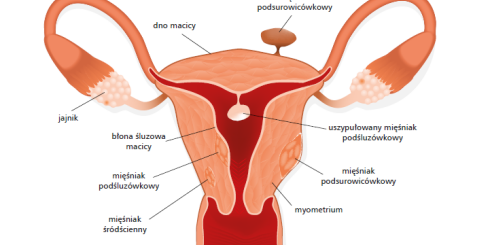 Mięśniaki macicy - czy operacja zawsze jest konieczna?