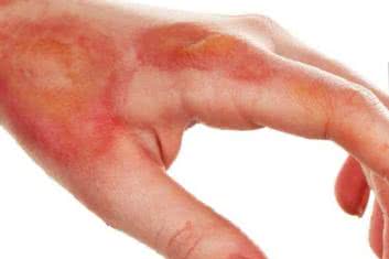 Trudno gojącymi się ranami