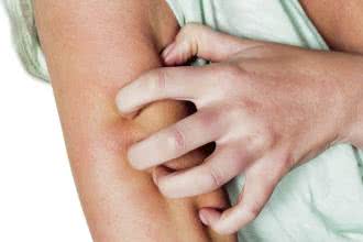 Atopowe zapalenie skóry (AZS): jak złagodzić objawy?