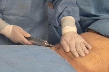 Komórki macierzyste w rekonstrukcji piersi