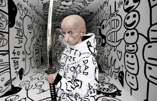 Progeria (przedwczesne starzenie) - objawy i leczenie