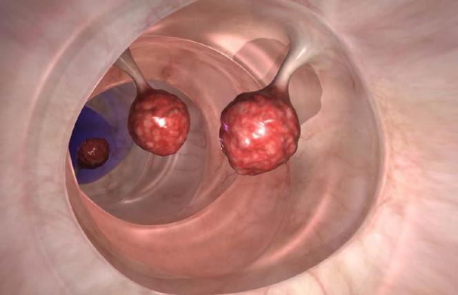 Polipy - umiejscowienie, objawy, diagnoza i leczenie