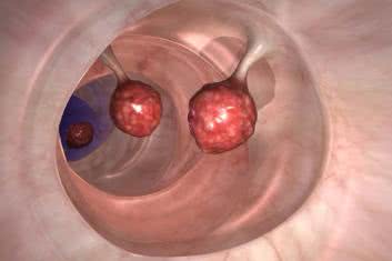 Łagodna ośmiornica