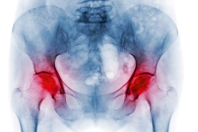 Osteopenia - badania, dieta i suplementy