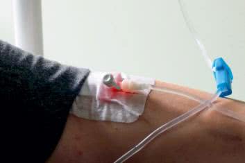 Kroplówka kontra złogi