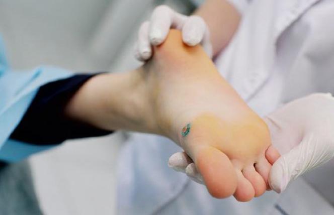 Czerniak: słońce czy genetyka?