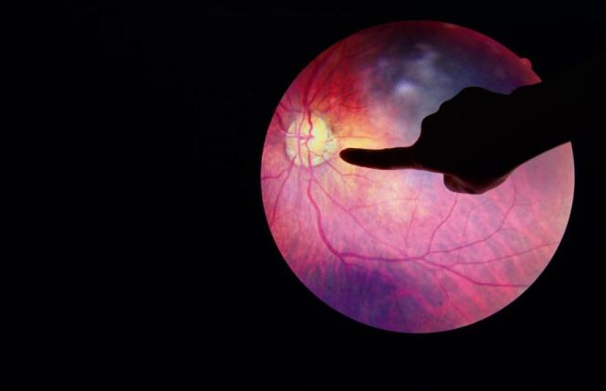 Retinopatia niejedno ma imię