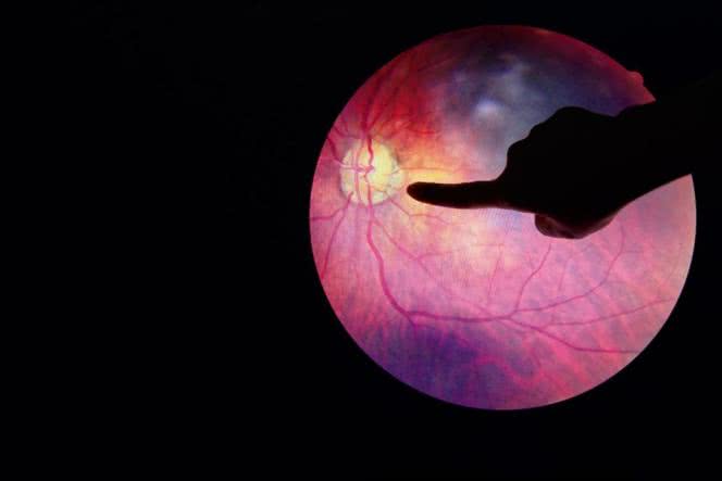 Retinopatia niejedno ma imię