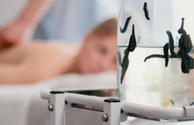 Hirudoterapia - na co pomaga leczenie pijawkami? 