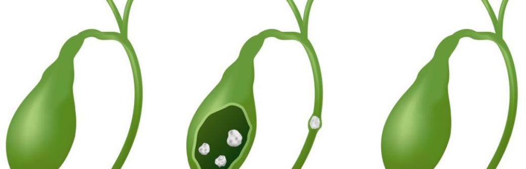 Naturalne leki i sposoby na kamienie żółciowe