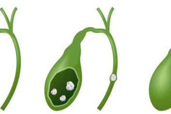 Złogi w pęcherzyku żółciowym - czy skalpel to jedyne rozwiązanie?