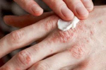 Atopowym zapaleniem skóry