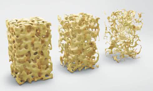 Pokonaj osteoporozę