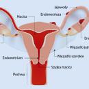 Endometrioza - przyczyny, objawy, alternatywne metody leczenia