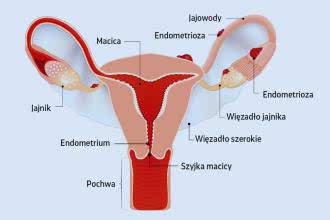 Endometrioza - przyczyny, objawy, alternatywne metody leczenia