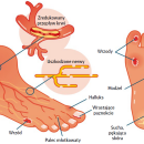Stopa cukrzycowa - jak zapobiegać i leczyć?