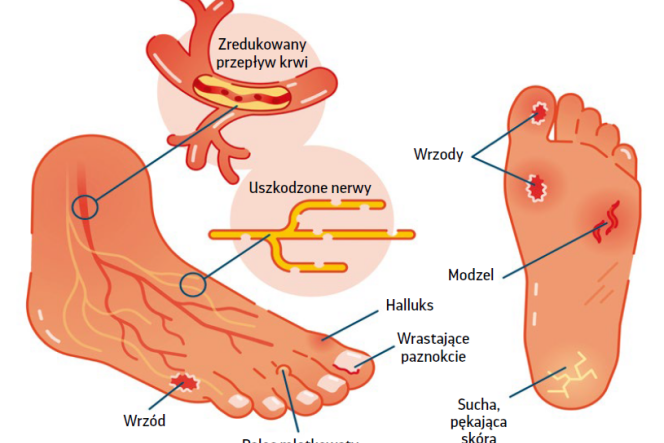 Stopa cukrzycowa - jak zapobiegać i leczyć?