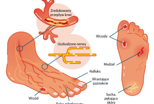 Stopa cukrzycowa - jak zapobiegać i leczyć?