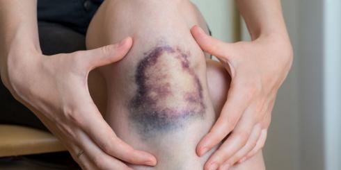 Siniaki - przyczyny i domowe sposoby na krwiaki