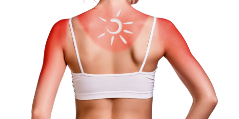 Oparzenia skóry - naturalne sposoby łagodzenia objawów