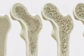 Osteoporoza - pierwiastki niezbędne dla kości