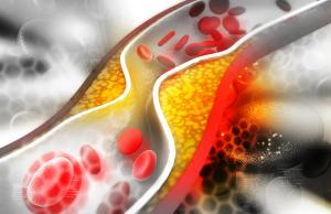 Wysoki cholesterol - jak z nim walczyć?