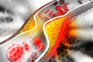 Wysoki cholesterol - jak z nim walczyć?