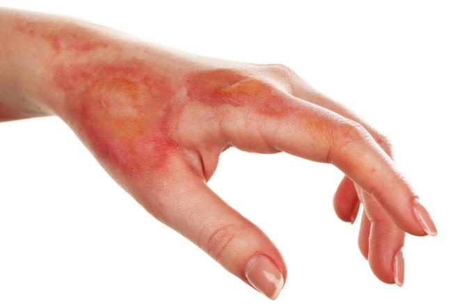 Atopowe zapalenie skóry - naturalne sposoby łagodzenia 