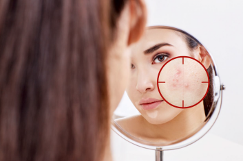 Gdy trądzik nie mija z wiekiem...