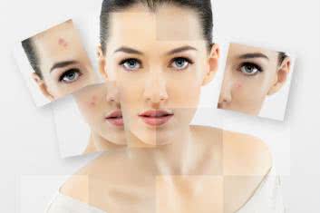 Pomoc dla cery naczynkowej 