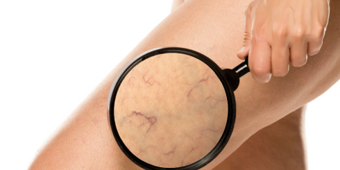 Żylaki kończyn dolnych - przyczyny, objawy, leczenie, dieta