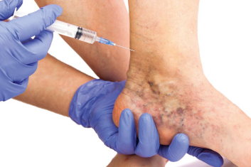 ŻYLAKI trzeba leczyć