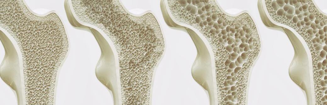 Światowy Dzień Chorych na Osteoporozę