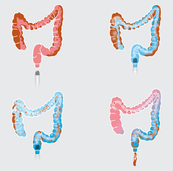Infografika: Stopniowe oczyszczanie jelita lewatywą